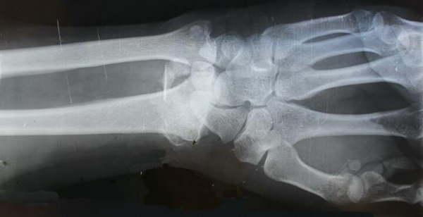 Estudantes de Enfermagem realizam estudo sobre dor crónica nas pessoas com doenças reumatológicas