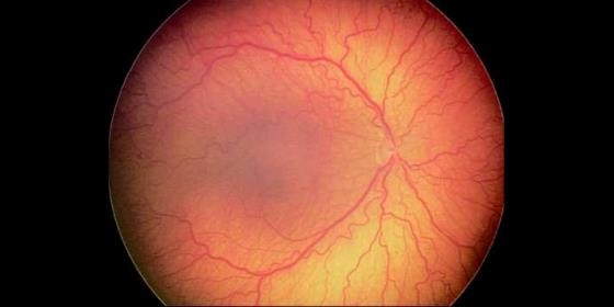 Investigadora de Coimbra estuda novas formas de combate à retinopatia diabética