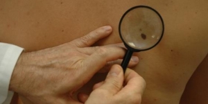 Rastreio de cancro de pele detetou 77 casos suspeitos em 2015