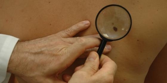 Rastreio de cancro de pele detetou 77 casos suspeitos em 2015