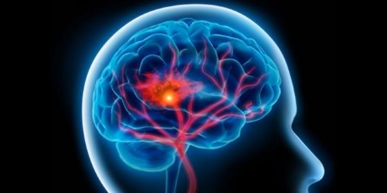 Doenças cerebrovasculares matam 30 pessoas por dia em Portugal