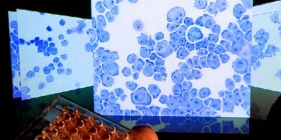 Novo tratamento para cancro com bons resultados, mas oneroso