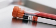 Análise de sangue pode determinar reaparecimento de cancro da mama