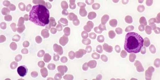 Identificado tratamento para evitar recaídas na leucemia mieloide crónica