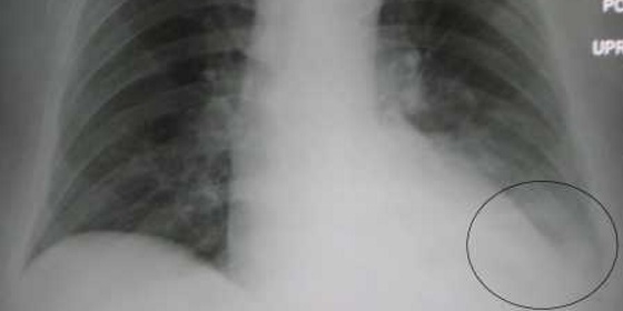 Portugal é segundo país da Europa com maior taxa de mortalidade por pneumonia